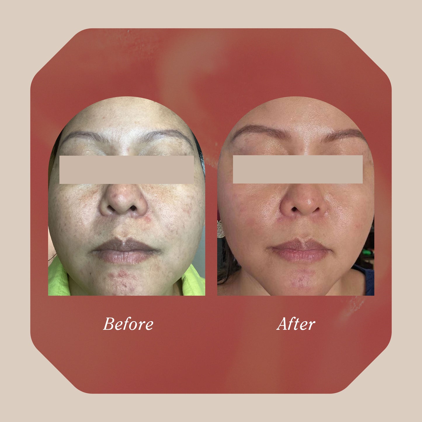 The Skin Reset Ritual - Face - Single Session