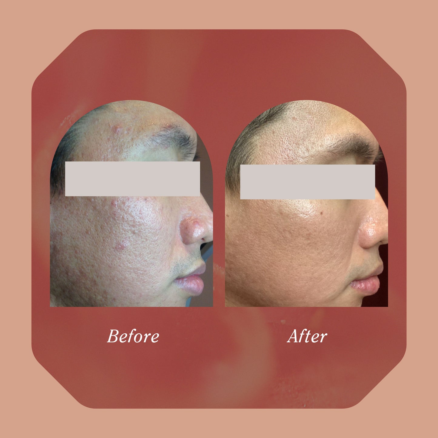 Lift + Restore Ritual - Progress Plan (Nurse's Price) – Simply Skin