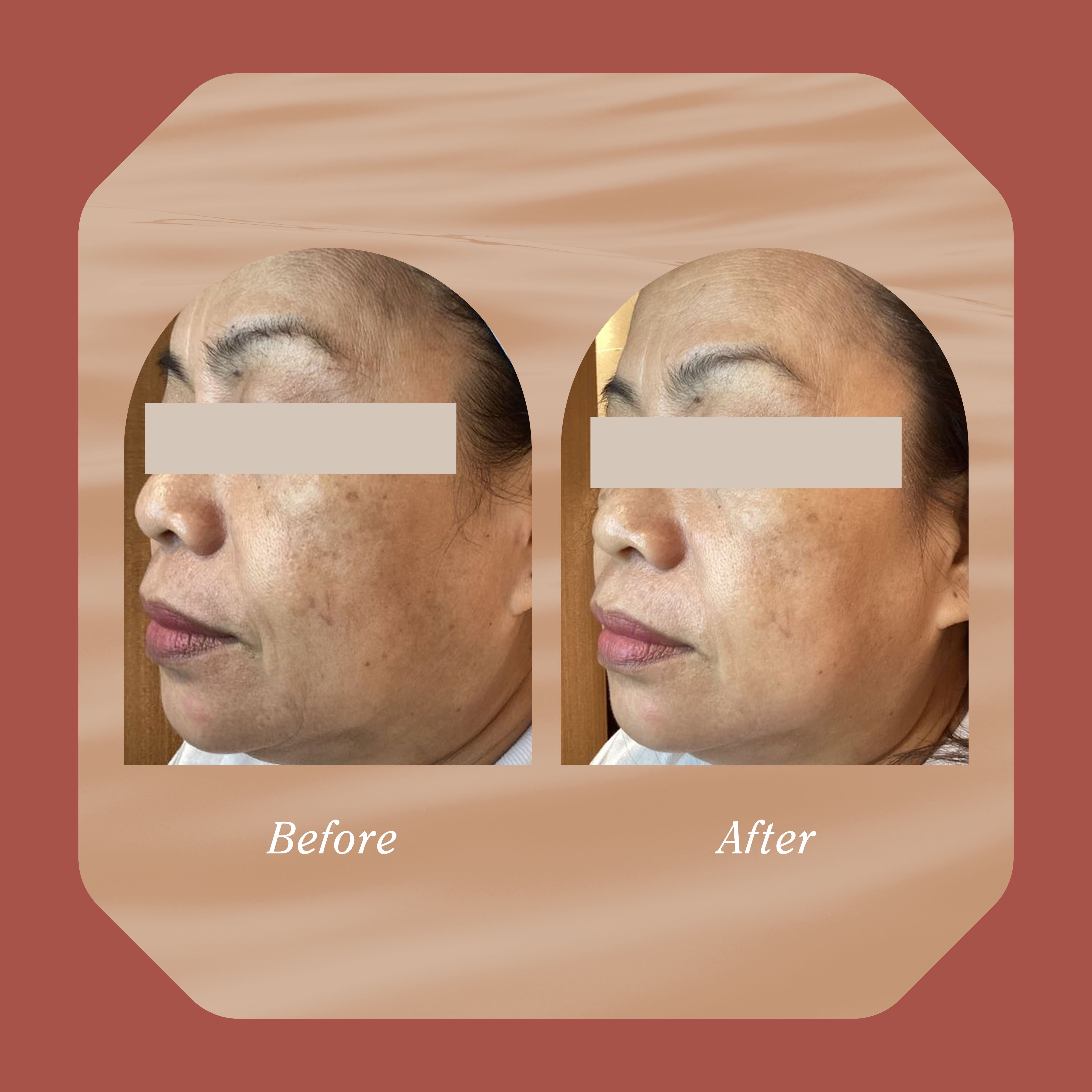 Clear + Lift Ritual - Single Session (Nurse's Price) – Simply Skin