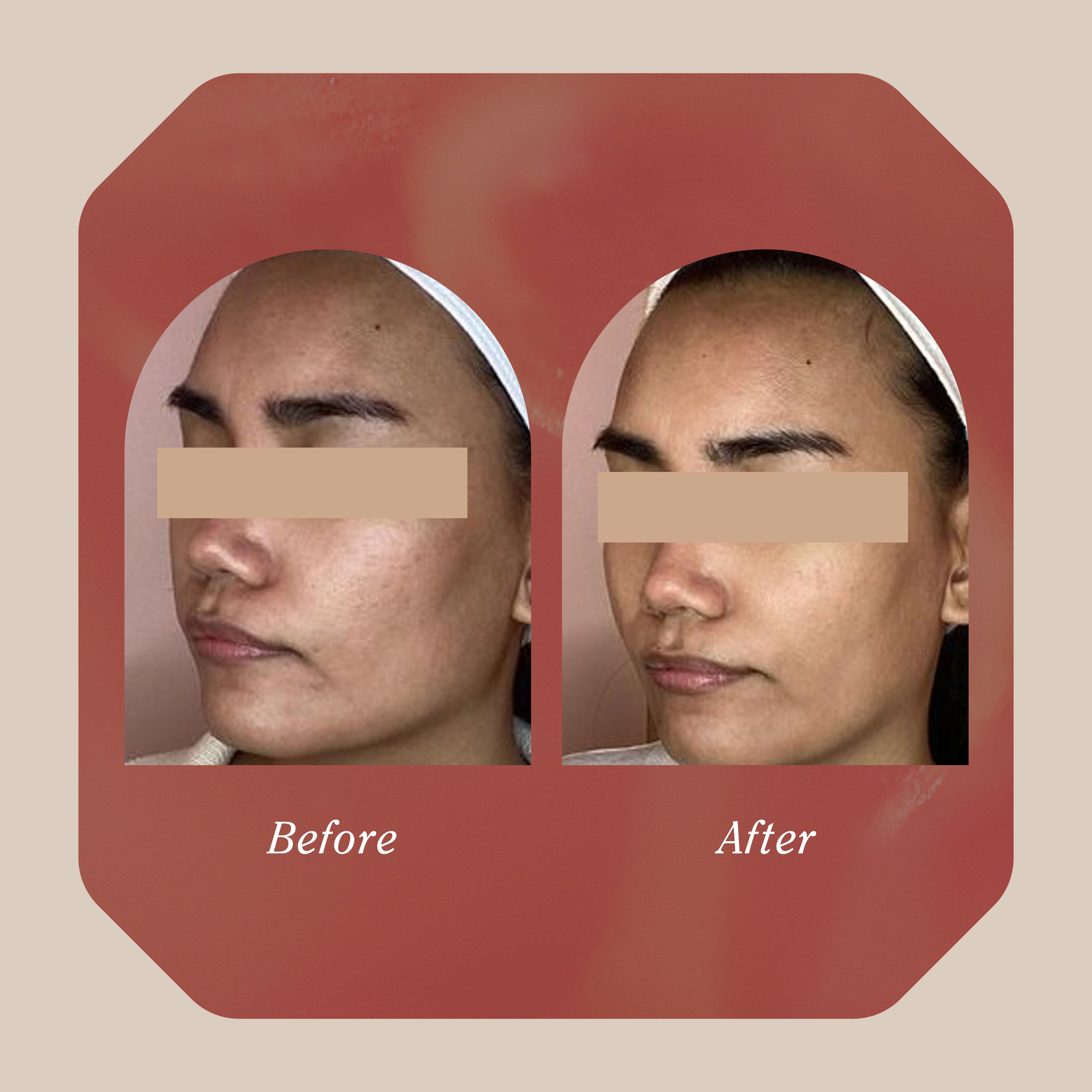 Lift + Restore Ritual - Single Session (Doctor's Price) – Simply Skin